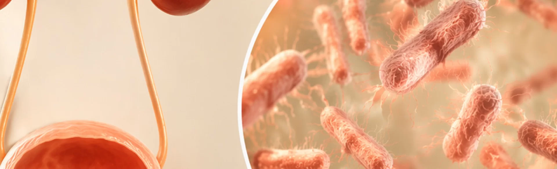 Zakażenie układu moczowego