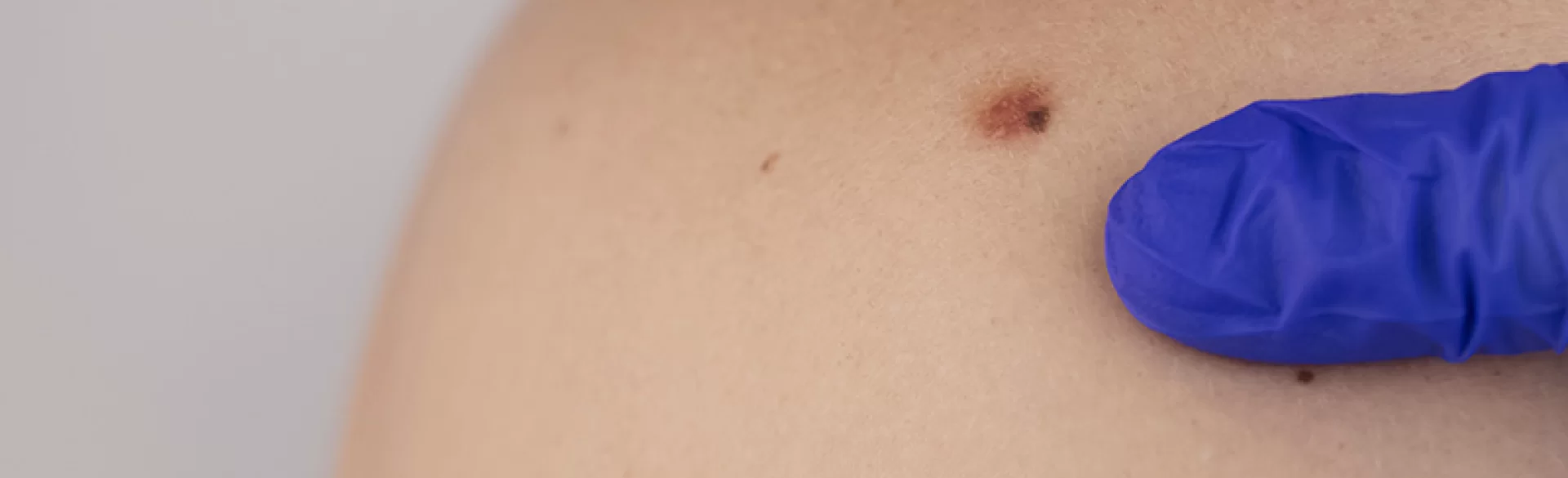 Znamię dysplastyczne