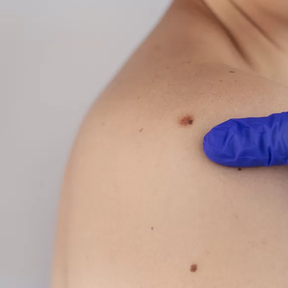 Znamię dysplastyczne