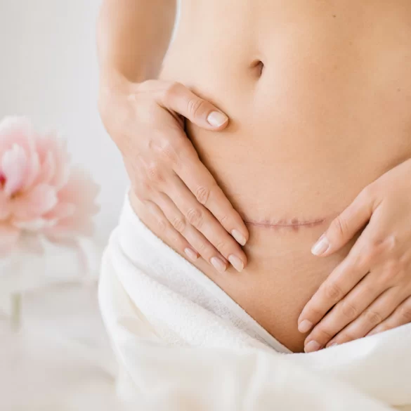 Zrosty po cesarskim cięciu