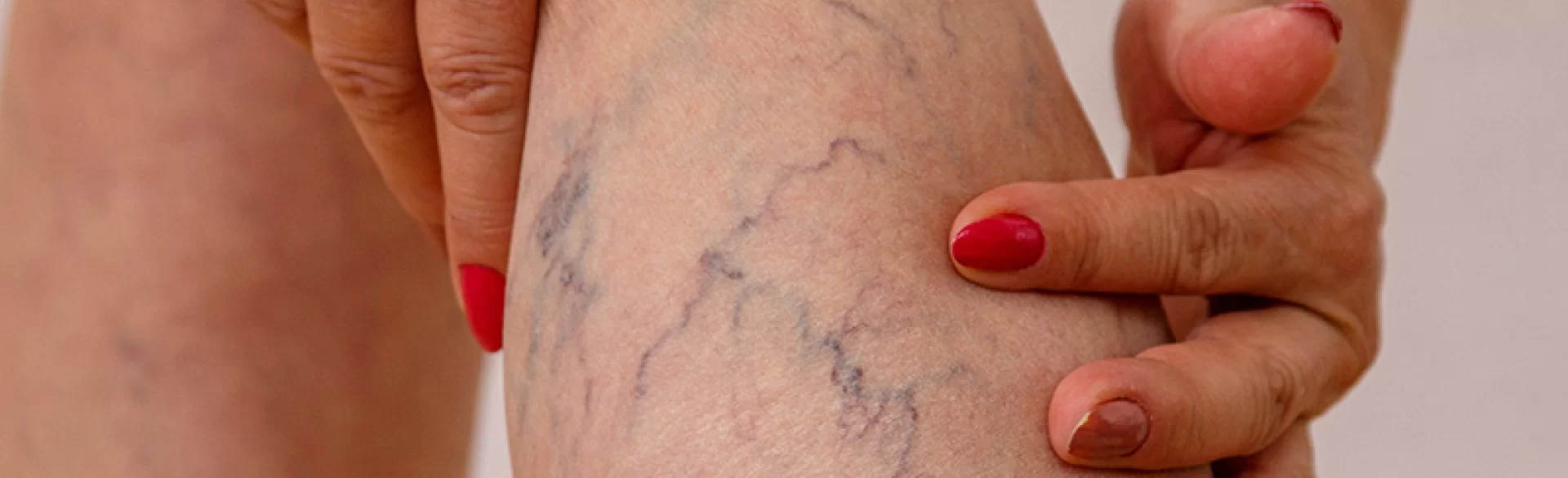 Żylaki pod kolanami