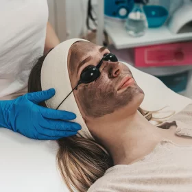 PEELING LASEROWY