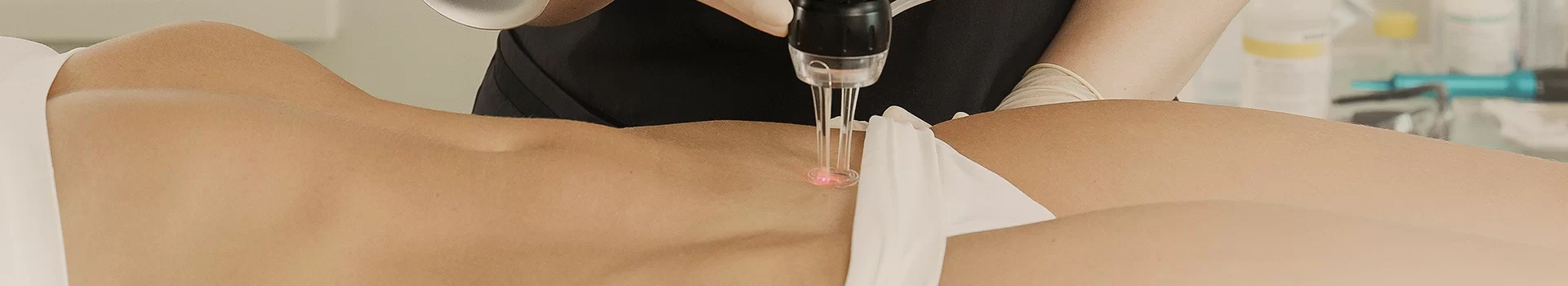 Laserowe usuwanie blizn po cięciu